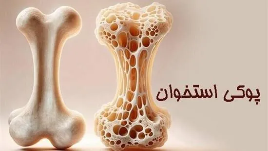 پوکی استخوان، بیماری خاموشی قابل پیشگیری با تشخیص زودهنگام