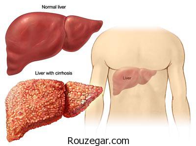 کبد چرب,درمان کبد چرب,علت کبد چرب,علائم ابتلا به کبد چرب
