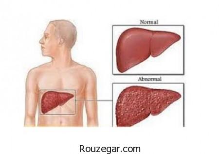 کبد چرب,درمان کبد چرب,علت کبد چرب,علائم ابتلا به کبد چرب