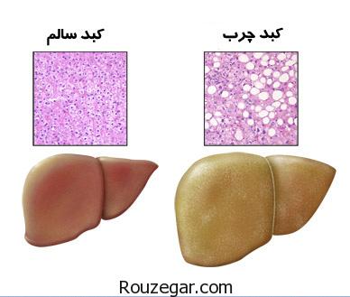 کبد چرب,درمان کبد چرب,علت کبد چرب,علائم ابتلا به کبد چرب