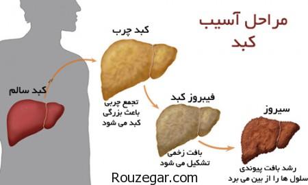 کبد چرب,درمان کبد چرب,علت کبد چرب,علائم ابتلا به کبد چرب