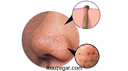 از بین بردن جوش های سرسیاه بینی