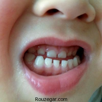 باعث دندان قروچه در کودکان چیست ، دندان قروچه کودک در بیداری ، علت فشار دادن دندانها روی هم ، فشار دادن دندانها روی هم در خواب