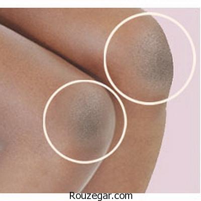 تیرگی زانوها,درمان تیرگی زانوها,برای رفع تیرگی زانوها