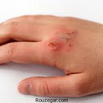 از بین بردن جای سوختگیهای سطحی