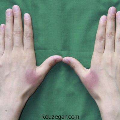 از بین بردن جای سوختگیهای سطحی