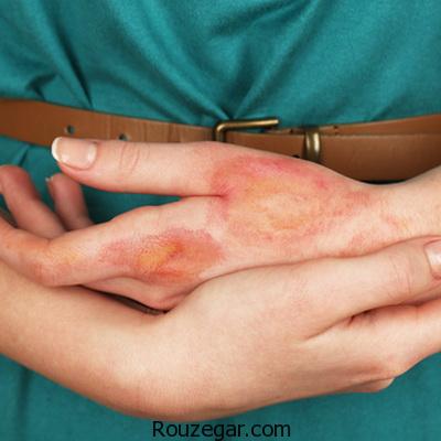 از بین بردن جای سوختگیهای سطحی