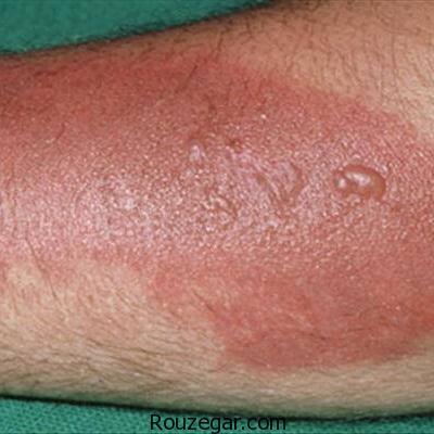 از بین بردن جای سوختگیهای سطحی