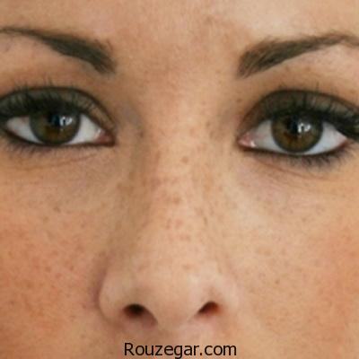 بهترین راه درمان کک و مک