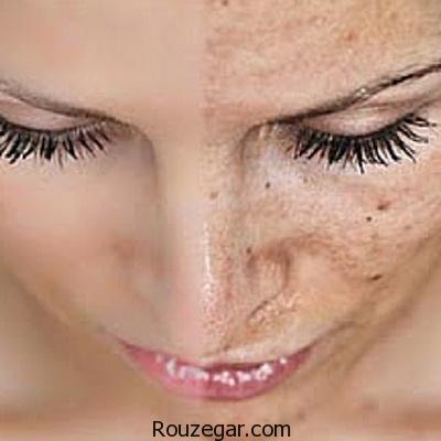 بهترین راه درمان کک و مک