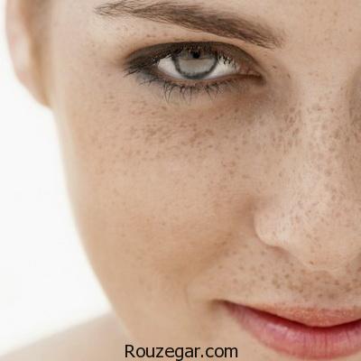 بهترین راه درمان کک و مک