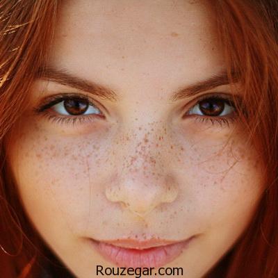 بهترین راه درمان کک و مک