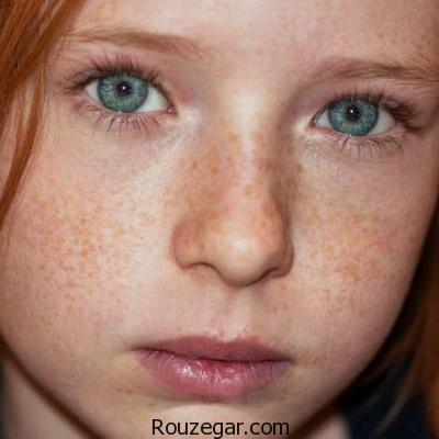 بهترین راه درمان کک و مک