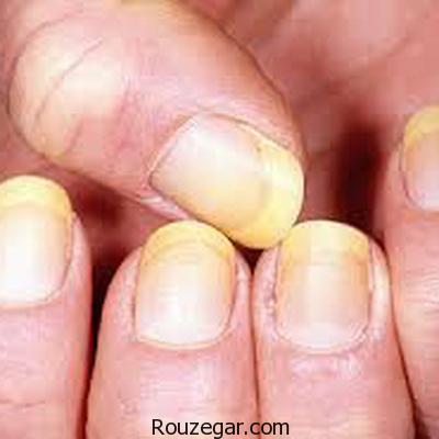 علت زرد شدن ناخن و راه درمان آن