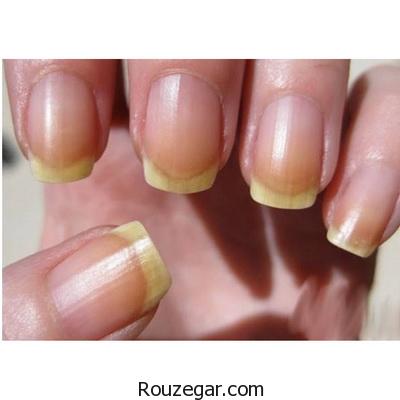 علت زرد شدن ناخن و راه درمان آن