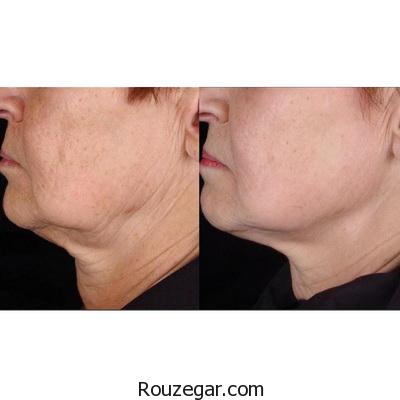 راه درمان برای سفت شدن پوست صورت و گردن