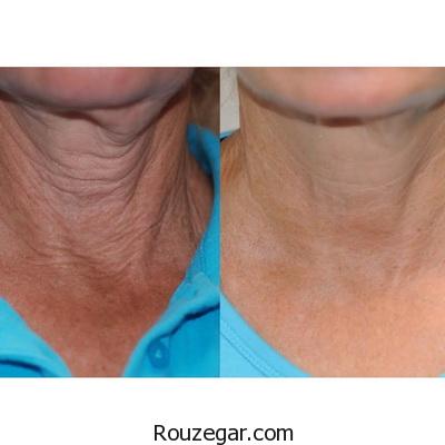 راه درمان برای سفت شدن پوست صورت و گردن