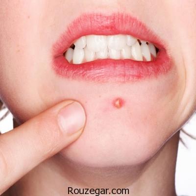 علت جوش های روی قسمت های مختلف صورت