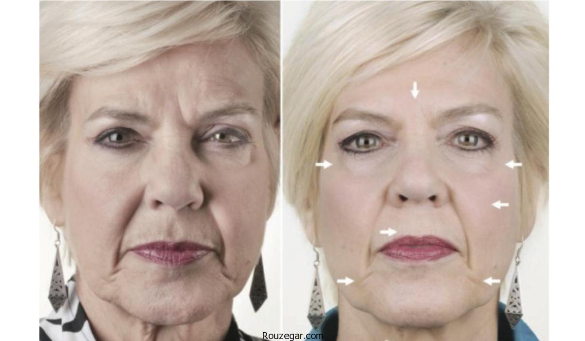 کاربرد طب سوزنی در زیبایی پوست صورت