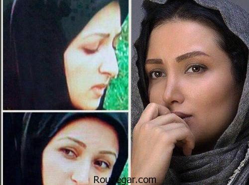 عکس دیده نشده از روناک یونسی قبل و بعد عمل زیبایی