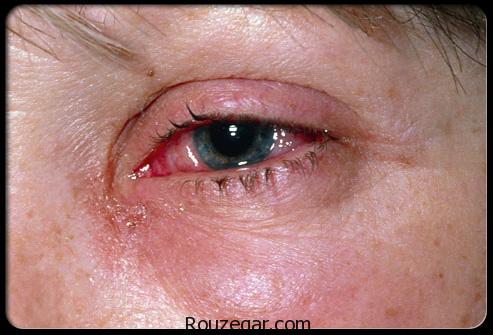 علت درد حدقه چشم,علت درد چشم چپ,علت چشم درد همراه با سردرد