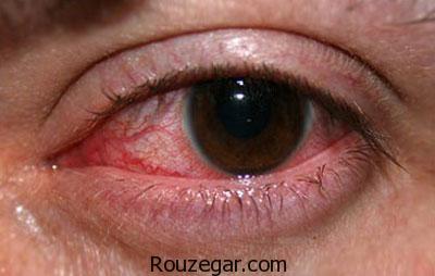علت درد حدقه چشم,علت درد چشم چپ,علت چشم درد همراه با سردرد