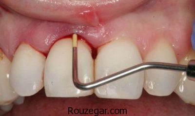 آبسه دندان در بارداری،درمان آبسه دندان با نشاسته،درمان آبسه دندان در طب سنتی