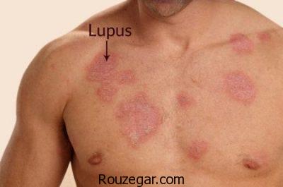 انواع بیماری لوپوس،علت ابتلا به بیماری لوپوس،بیماری لوپوس و بارداری