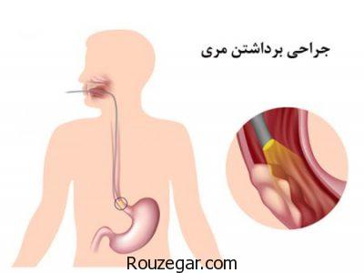 مری بارت مری بارت,علائم بیماری مری بارت,درمان مری بارت,درمان گیاهی مری بارت,نشانه های مری بارت,تشخیص مری بارت,درمان خانگی مری بارت,بیماری مری بارت چیست,علائم مری بارت,مری بارت چیست
