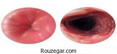 مری بارت مری بارت,علائم بیماری مری بارت,درمان مری بارت,درمان گیاهی مری بارت,نشانه های مری بارت,تشخیص مری بارت,درمان خانگی مری بارت,بیماری مری بارت چیست,علائم مری بارت,مری بارت چیست