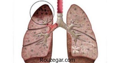 داروی آبسه ریه،درمان سریع آبسه ریه،درباره آبسه ریه