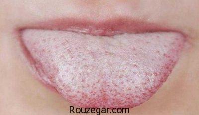  درمان سریع آفت دهان،درمان گیاهی آفت دهان،علت بروز آفت دهان