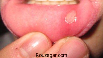  درمان سریع آفت دهان،درمان گیاهی آفت دهان،علت بروز آفت دهان