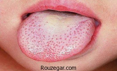  درمان سریع آفت دهان،درمان گیاهی آفت دهان،علت بروز آفت دهان