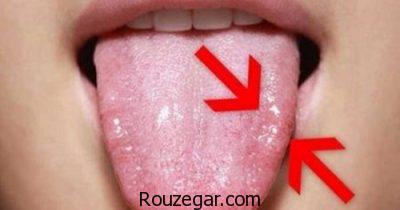  درمان سریع آفت دهان،درمان گیاهی آفت دهان،علت بروز آفت دهان
