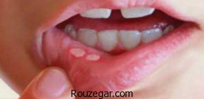  درمان سریع آفت دهان،درمان گیاهی آفت دهان،علت بروز آفت دهان