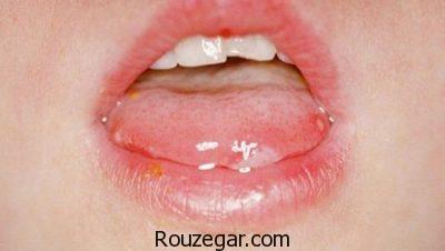  درمان سریع آفت دهان،درمان گیاهی آفت دهان،علت بروز آفت دهان