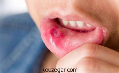  درمان سریع آفت دهان،درمان گیاهی آفت دهان،علت بروز آفت دهان