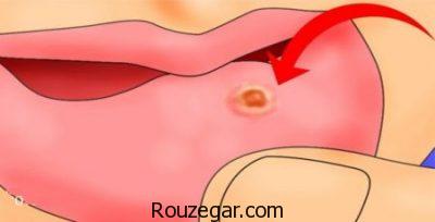  درمان سریع آفت دهان،درمان گیاهی آفت دهان،علت بروز آفت دهان