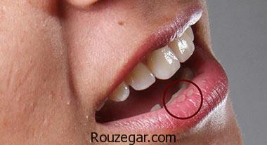  درمان سریع آفت دهان،درمان گیاهی آفت دهان،علت بروز آفت دهان