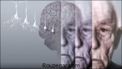درمان آلزایمر شدید،نشانه های آلزایمر،داروهای ضد آلزایمر