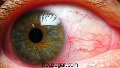 التهاب عنبیه در کودکان،روش درمان التهاب عنبیه،التهاب عنبیه چیست