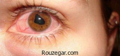 التهاب عنبیه در کودکان،روش درمان التهاب عنبیه،التهاب عنبیه چیست