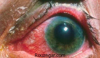 التهاب عنبیه در کودکان،روش درمان التهاب عنبیه،التهاب عنبیه چیست