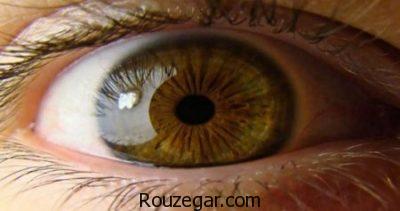 التهاب عنبیه در کودکان،روش درمان التهاب عنبیه،التهاب عنبیه چیست