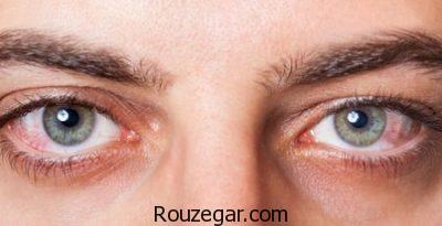 التهاب عنبیه در کودکان،روش درمان التهاب عنبیه،التهاب عنبیه چیست