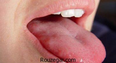 التهاب زبان و دهان،التهاب زبان نوزاد،درمان گیاهی التهاب زبان