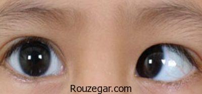 علل ایجاد انحراف چشم،علائم انحراف چشم مخفی،انحراف چشم در نوزاد