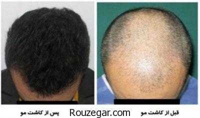 طول درمان کاشت مو،عوارض کاشت مو،جدیدترین روش کاشت مو