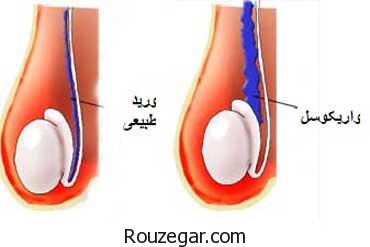 نازایی در مردان چیست،علت نازایی در مردان،درمان گیاهی نازایی در مردان